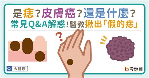 痣長毛|是痣or皮膚癌？醫「1張圖秒對照」 長這2部位最危險